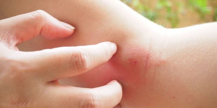 Picadura de alacranes: prevención y atención médica