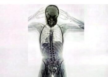 En Ezeiza Impresionante imagen de un escáner de rayos X: una mula tenía 78 cápsulas de cocaína en el cuerpo