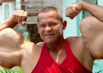 Prácticas de riesgo Murió “Popeye brasileño”: el fisicoculturista que se inyectaba aceite para aumentar sus bíceps